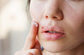 Doofer Lippenherpes